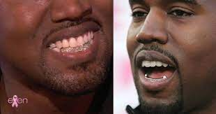 Kanye teeth with diamond grill smile 
