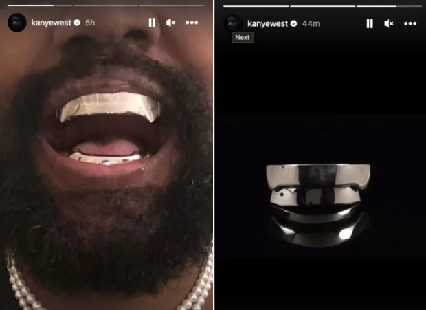 Kanye teeth controversy diamond smile live performance 