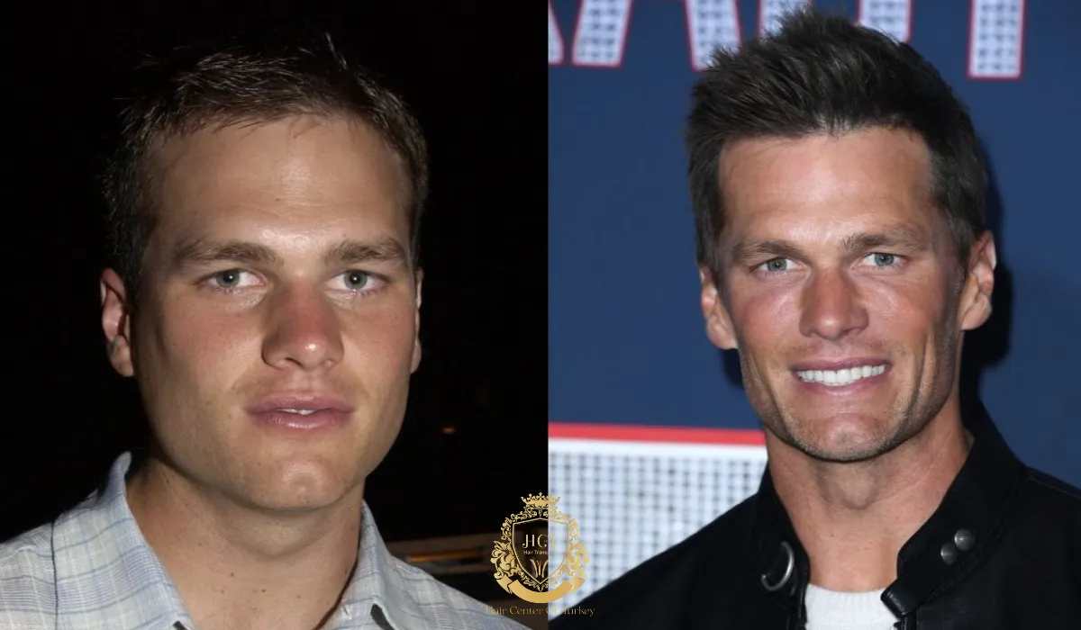 Tom Brady hair transplant vs other celebrity hairlines 