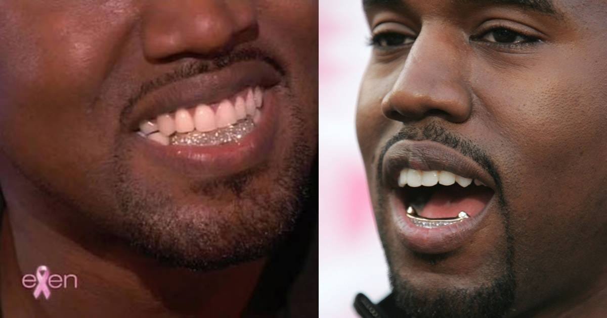 Kanye West Teeth Facts