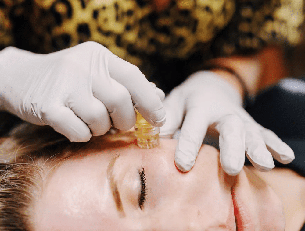 Aquagold luxury microneedling treatment session
