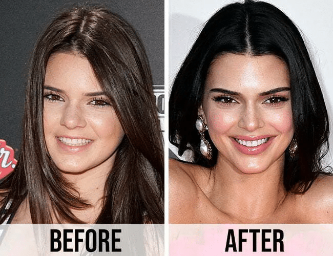 (title)% Kendall Jenner before and after photos highlighting surgery rumors