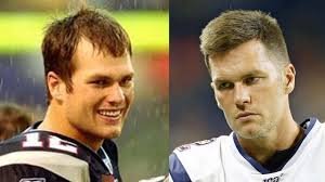 Tom Brady Hair Transplant Truths