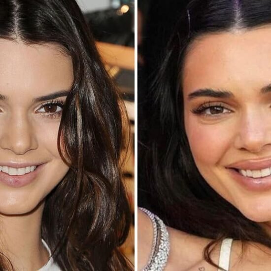 Kendall Jenner Plastic Surgery: 7 Shocking Truths, Praise & Criticism