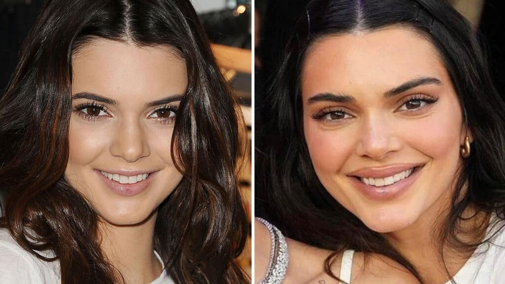 Kendall Jenner Plastic Surgery: 7 Shocking Truths, Praise & Criticism