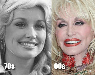 Dolly Parton before plastic surgery, natural beauty in the 1970s